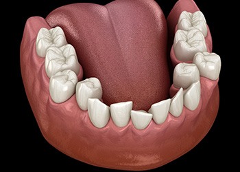 Illustration of crooked teeth