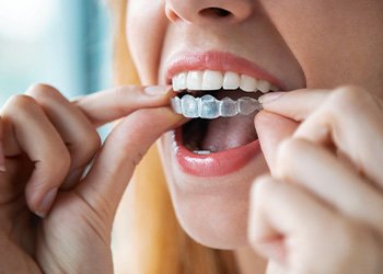 Patient putting on clear aligner