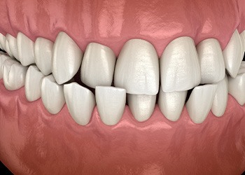 Illustration of a crossbite