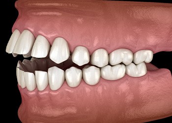 Illustration of an open bite