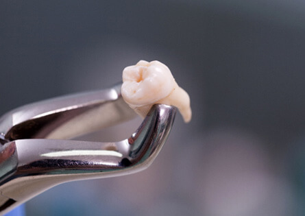 dental forceps holding extracted tooth